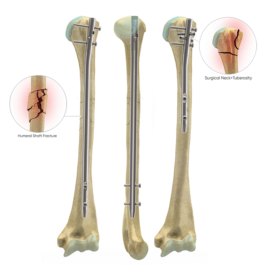 Cannulated Intramedullary Humeral Nail System