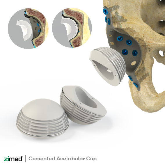 Cemented Acetabular Cup