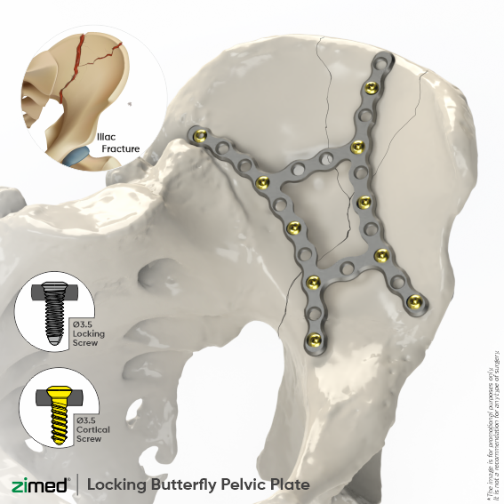 Locking Butterfly Pelvic Plates