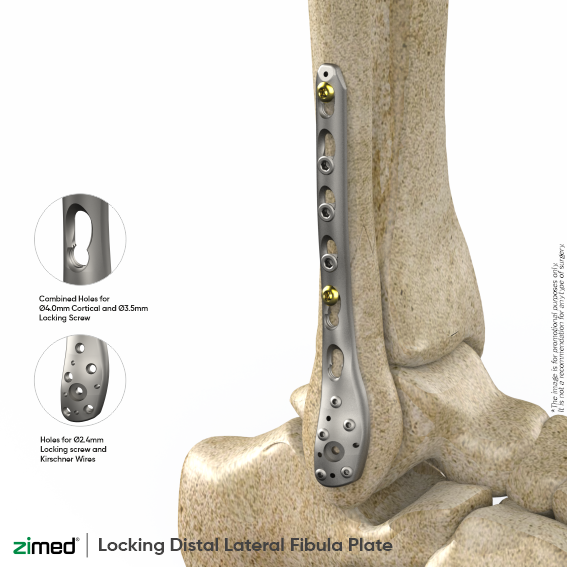 Locking Distal Lateral Fibula Plates