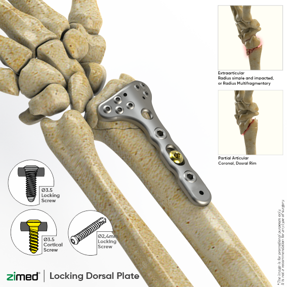 Locking Distal Radius Plates - Dorsal