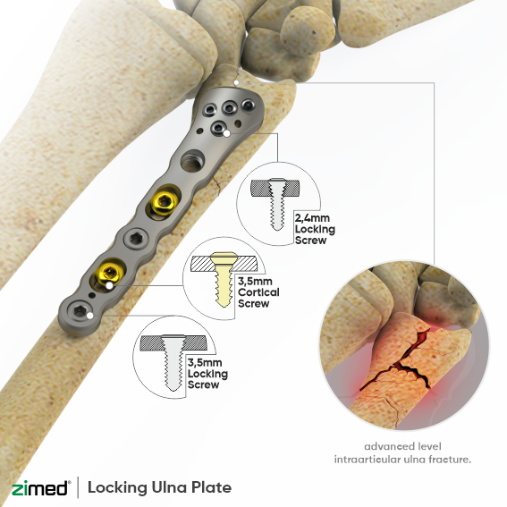 Locking Distal Ulna Plates