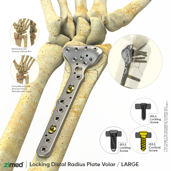 Locking Distal Radius Plates Volar LARGE Small Fragment Locking 