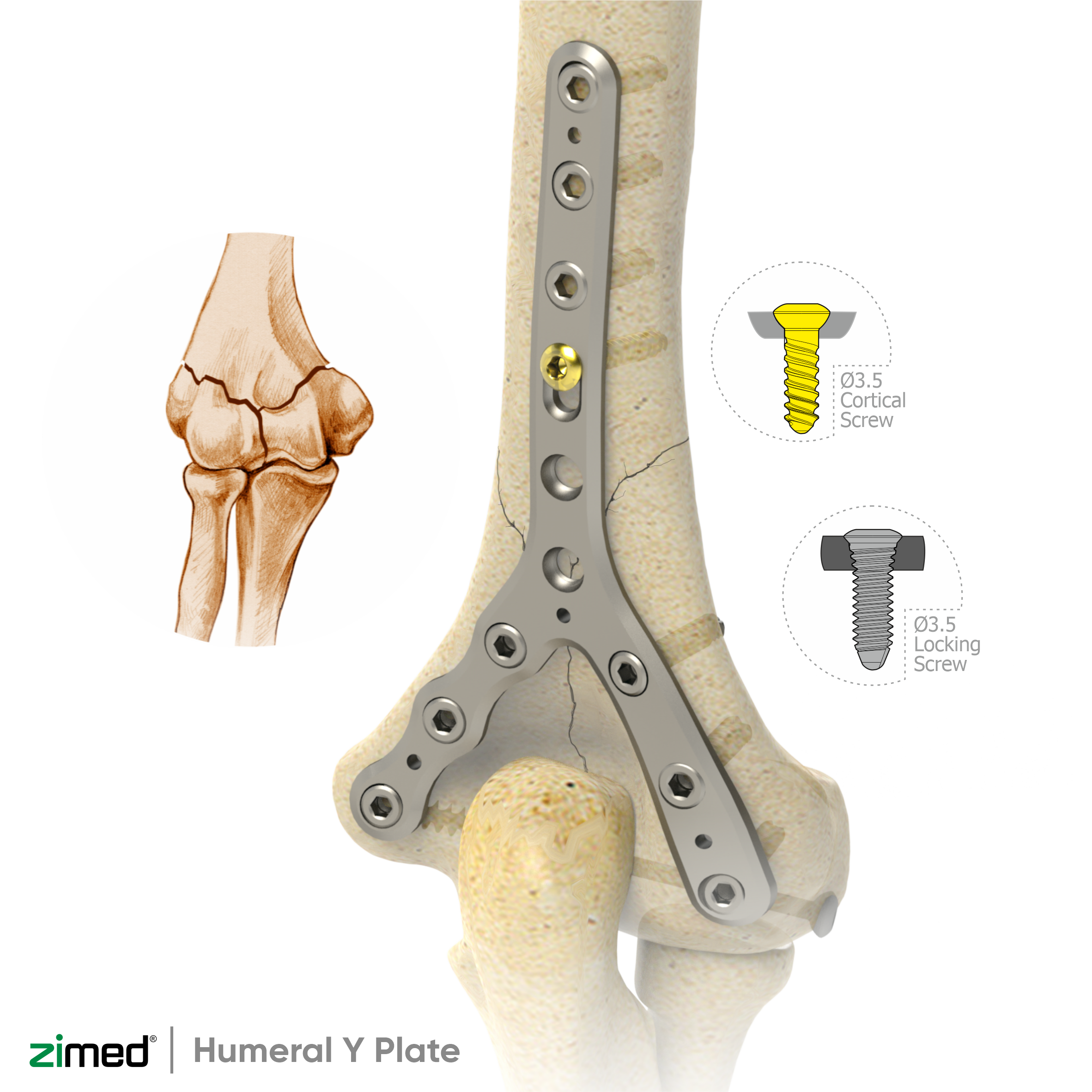 Locking Distal Humeral Y Plate